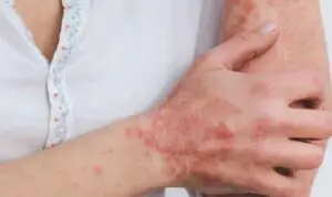 Antalya’da düzenlenen 31’inci Ulusal Dermatoloji Kongresi‘nde Prof. Dr. Durdu, uyuzla