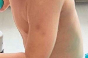 3 yaşındaki otizmli &ccedil;ocukları Mert&rsquo;in anaokulundan d&ouml;nd&uuml;ğ&uuml;nde v&uuml;cudundaki morlukları g&ouml;ren