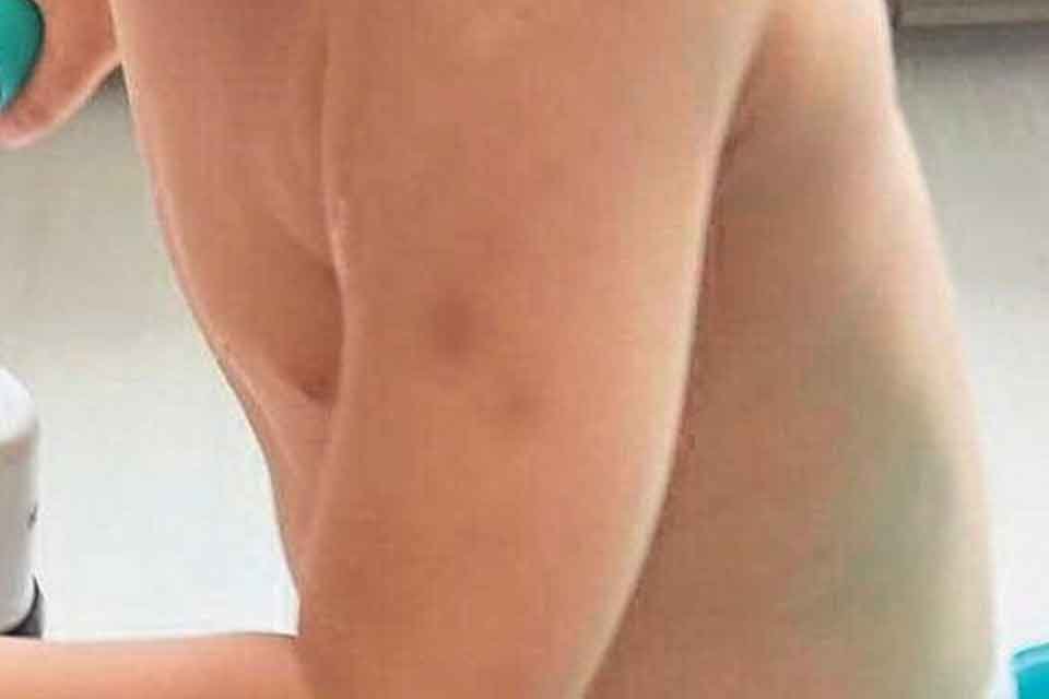 3 yaşındaki otizmli &ccedil;ocukları Mert&rsquo;in anaokulundan d&ouml;nd&uuml;ğ&uuml;nde v&uuml;cudundaki morlukları g&ouml;ren