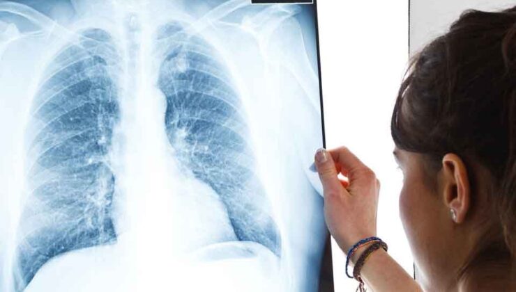 Bilim Kurulu Üyesi açıkladı: Korona akciğerde hasar bırakır mı?