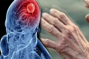 Parkinson hastalığının beyinde dopamin adı verilen beyin h&uuml;crelerinin birbirleriyle haberleşmesini