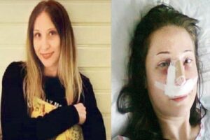 Burun estetiği ameliyatı olan Sevin&ccedil; &Ccedil;elik&rsquo;in hayatı karardı. Ameliyattan sonra