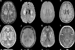 ABD'de Covid-19 nedeniyle yaşamını yitirenlerin beyinlerine otopsi yapıldı. D&uuml;nyada milyonlarca