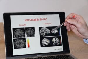 T&uuml;rkiye'de yaklaşık 50 kişide 1 g&ouml;r&uuml;len bipolar bozukluk hakkında bilgi