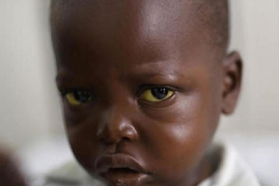 D&uuml;nya Sağlık &Ouml;rg&uuml;t&uuml; (DS&Ouml;), Nijerya'da 160 milyon kişinin sarıhumma salgını