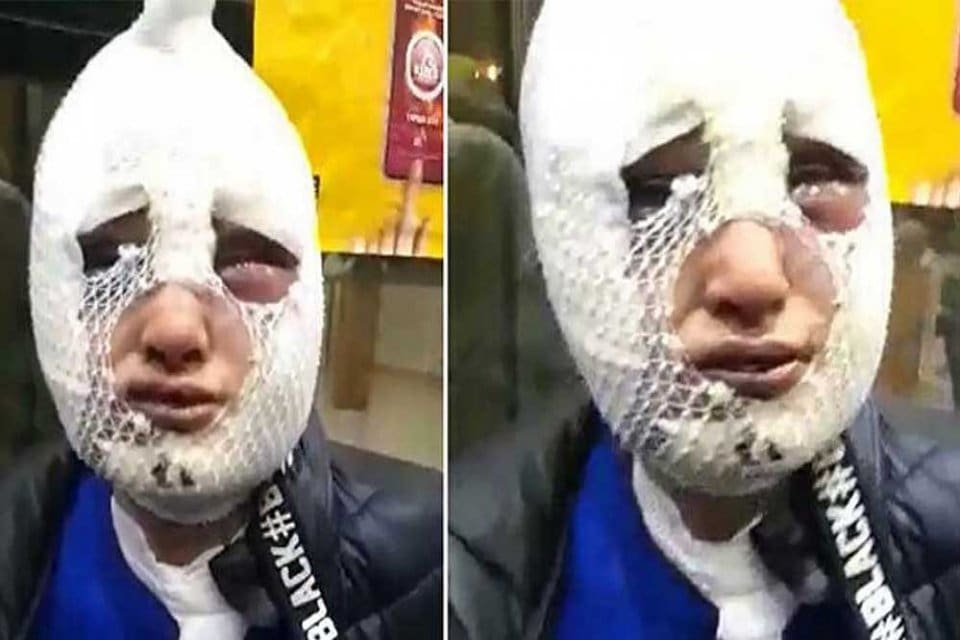 Hatay'da ge&ccedil;en yıl eski kız arkadaşının y&uuml;z&uuml;ne kızgın yağ d&ouml;ken