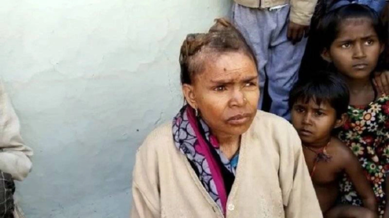 Hindistan'da bir kadının başının &uuml;st&uuml;nde ağrı yapan 'boynuzlar' oluşmasına doktorlar