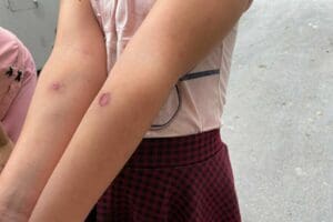 İstanbul'da &ouml;zellikle &ccedil;ocukların v&uuml;cutlarında yara oluşmasına neden olan sivrisinekler bir&ccedil;ok
