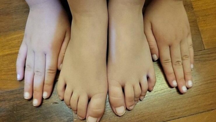Koronavirüste bir garip semptom: Küçük çocuğun el ve ayakları…