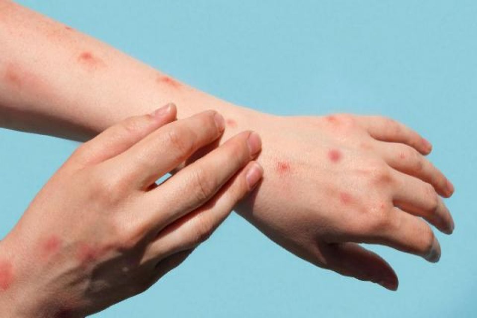 Kuzey Kıbrıs Türk Cumhuriyeti'nde bir kişide maymun çiçeği virüsü tespit