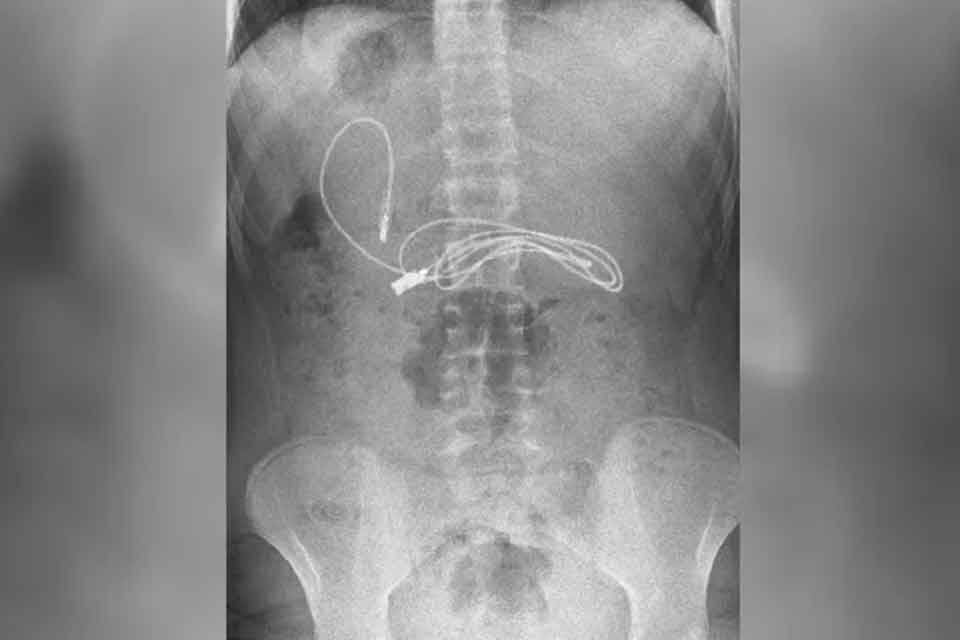 Kusma ve bulantı şikayetiyle hastaneye g&ouml;t&uuml;r&uuml;len erkek &ccedil;ocuğunun &ccedil;ekilen r&ouml;ntgeninde,
