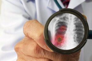 N&ouml;roloji Uzmanı Prof. Dr. Yakup Krespi, koronavir&uuml;sle birlikte gelen 'inme'