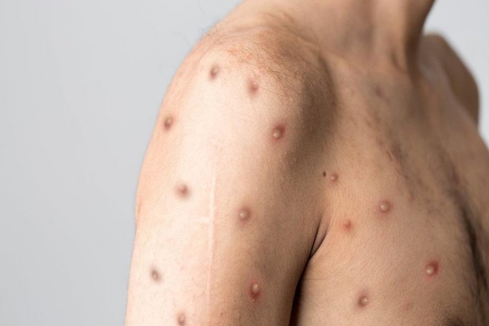 Rusya'da ilk kez bir kişide maymun &ccedil;i&ccedil;eği vir&uuml;s&uuml;n&uuml;n tespit edildiği