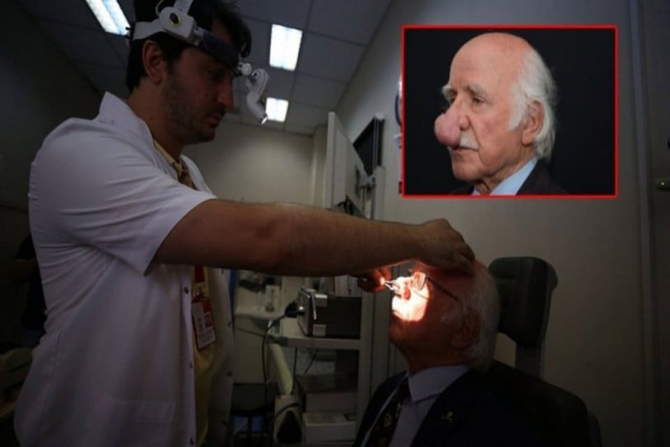 Trabzon'da yaşayan 84 yaşındaki Faik Ramoğlu'nun burnunda oluşan 100 gram