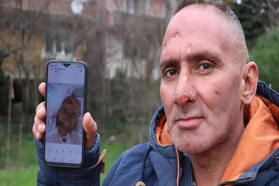 Zonguldak'ta yaşayan Murat Terzi&rsquo;nin y&uuml;z&uuml;, &ccedil;alışmaya gittiği Antalya'da, Afrika sineğinin