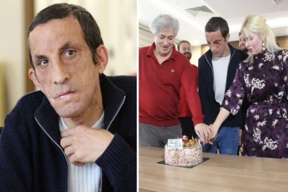 Akdeniz &Uuml;niversitesi Hastanesi'nde ger&ccedil;ekleştirilen T&uuml;rkiye'nin ilk y&uuml;z naklinin &uuml;zerinden 11