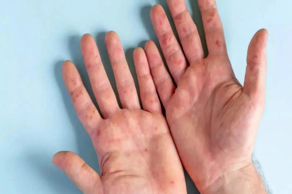 Uzmanlar yeni salgın için uyardı: Domates gribi! Bir tarafta corona virüsü salgını, bir tarafta maymun çiçeği devam