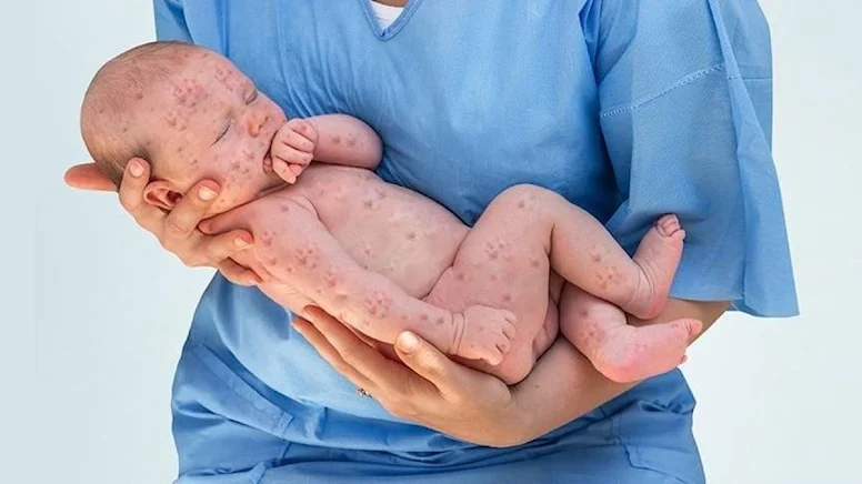 Türk Tabipleri Birliği (TTB) Aile Hekimliği Kolu (AHEK), kızamık vakalarının