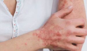 Antalya’da düzenlenen 31’inci Ulusal Dermatoloji Kongresi‘nde Prof. Dr. Durdu, uyuzla