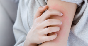 Türkiye’de dermatoloji polikliniklerine başvuran her 100 kişiden 30’u uyuz teşhisi