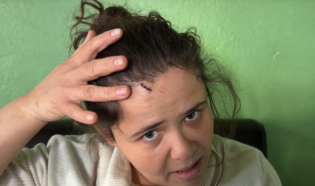 Muğla'da boşanma aşamasındaki eşi U.B. (42) tarafından darbedilen ve başına