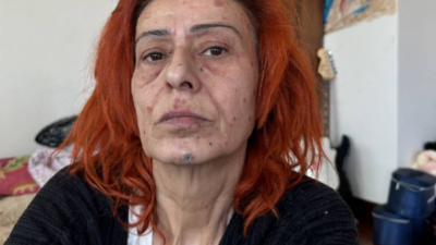 Yıldız Tilbe, saç boyası nedeniyle yüzünde kimyasal yanıklar oluştuğunu açıkladı.