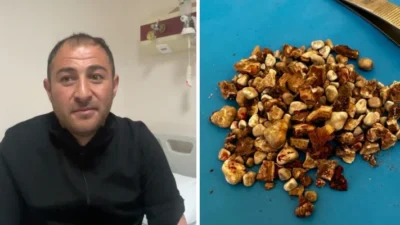 Kars'ta ameliyat edilen Ahmet Yarba'nın iki böbreğinden irili ufaklı 300'ü