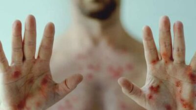 Dünya Sağlık Örgütü’nün son raporuna göre, Türkiye’de temmuz ayında 30’a