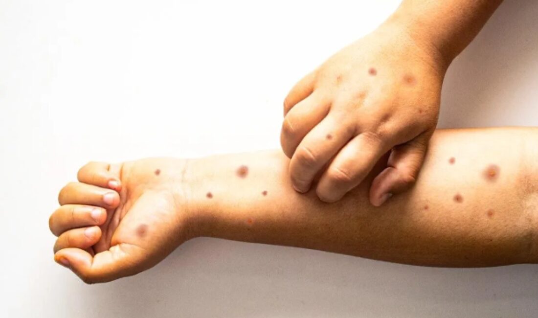 ış aylarının gelmesi ve kapalı alanlarda geçirilen sürenin artmasıyla birlikte,